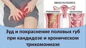 Зуд и покраснение половых губ при кандидозе и хроническом трихомониазе