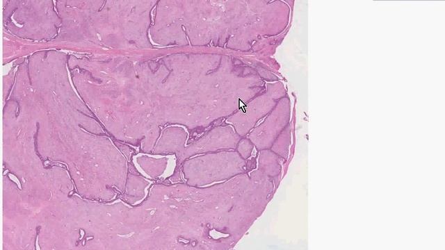 Histopathology Breast--Fibroadenoma смотреть онлайн