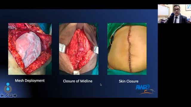 Posterior Component Separation Technique for Loss of Domain - Dr. Ramesh Punjani #LOD2021 #AWRSC смотреть онлайн