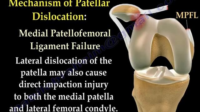 Patellar Dislocations - Everything You Need To Know - Dr. Nabil Ebraheim смотреть онлайн