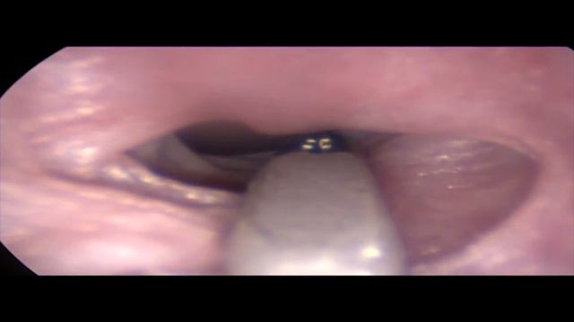Method of endoscopic extraction of the hook from dog's esophagus Способ удаления крючка из пищевода смотреть онлайн