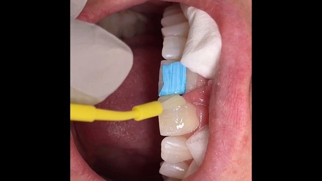 Houston Cosmetic Dentist...Reversible Cosmetic Bonding...No more front tooth gap! смотреть онлайн