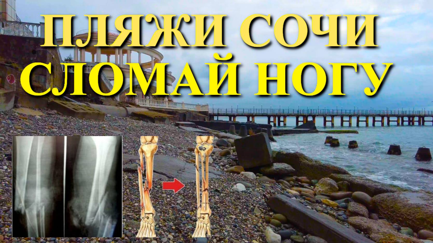 Переезд в Сочи, отдых в Сочи, перелом кости, Пляжи Мацеста, Сочи сегодня, Черное море сегодня смотреть онлайн