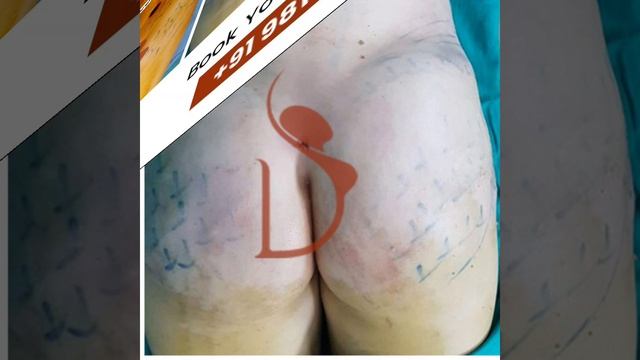 Amazing Results Of BBL (Brazilian Buttock Lift)