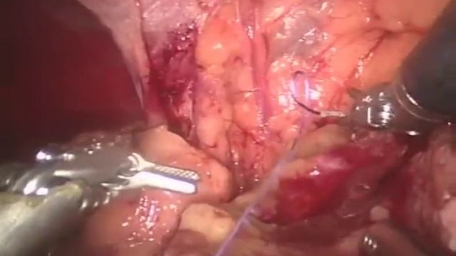 Robotic Partial Nephrectomy - Early Unclamping Technique смотреть онлайн