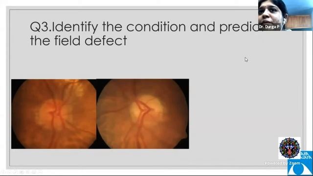 iFocus Online Session #76, Anatomy of the Visual Pathways by Dr Durga Priyadarshini смотреть онлайн
