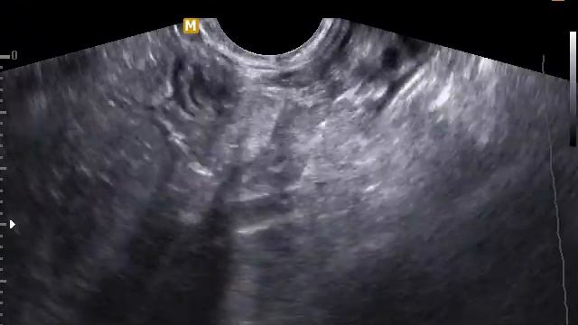 Аппендикс, находки при исследовании малого таза смотреть онлайн