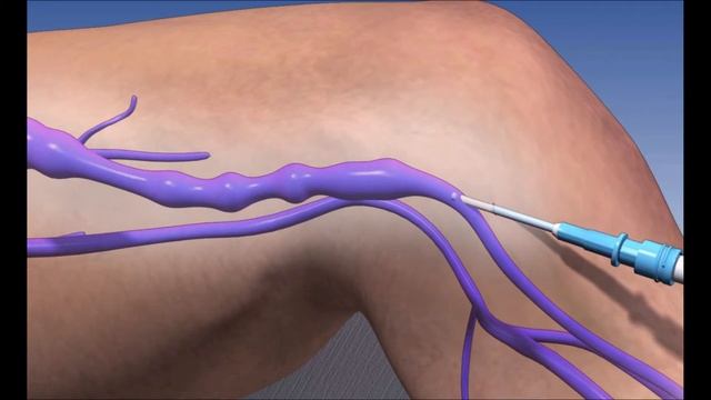 Лазерное удаление вен (Эндоваскулярная лазерная коагуляция вен) смотреть онлайн