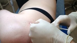 Гипертрофический рубец лечение дипроспаном