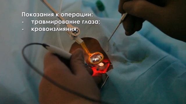 Витреоэктомия: удаление стекловидного тела смотреть онлайн