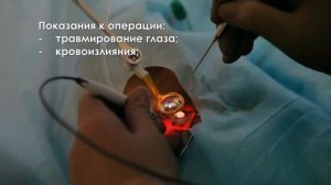 Витреоэктомия: удаление стекловидного тела