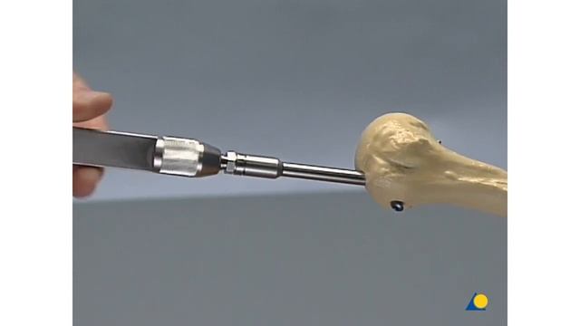 Humerus - Fractures - The Unreamed Humeral Nail (UHN) смотреть онлайн