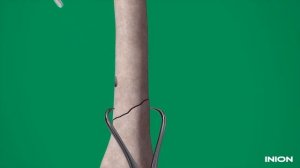 Установка биодеградируемого винта Inion Freedom™