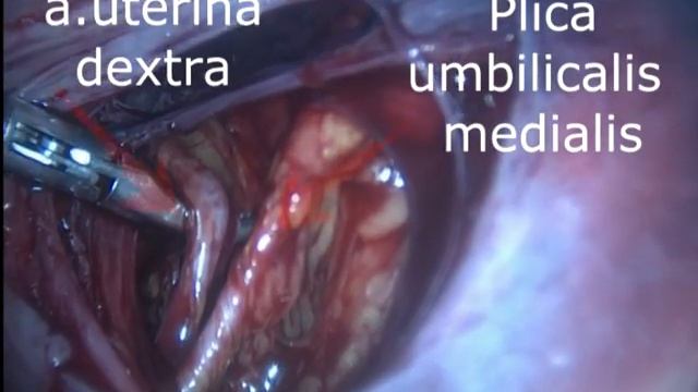 LS перевязка маточных артерий , миомэктомия смотреть онлайн