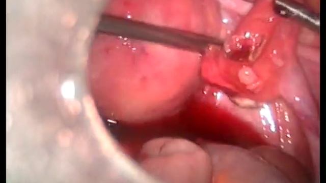 Лапароскопическая сальпинготомия, сальпингорафия смотреть онлайн