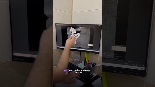 Как проходит синус-лифтинг? смотреть онлайн