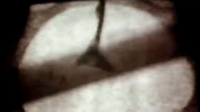 Бесплодие, непроходимость маточных труб © Infertility, Obstruction Of The Fallopian Tubes