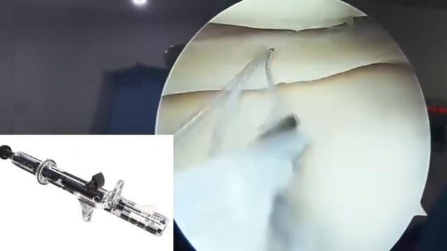 Meniscus Repair All Inside Technique with Latest “AIR+“ Device смотреть онлайн