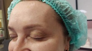 Рефайнекс до-после(2)