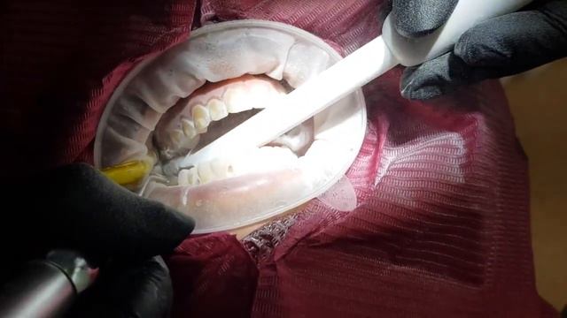 Профессиональная чистка зубов смотреть онлайн