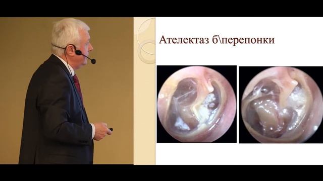 Діагностика секреторного отиту смотреть онлайн