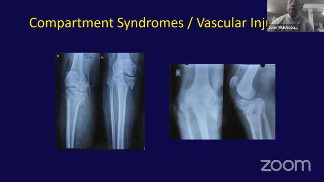 OREF Web-class for Orthopaedic Postgraduates on OrthoTV Dr JohnMukhopadhaya смотреть онлайн