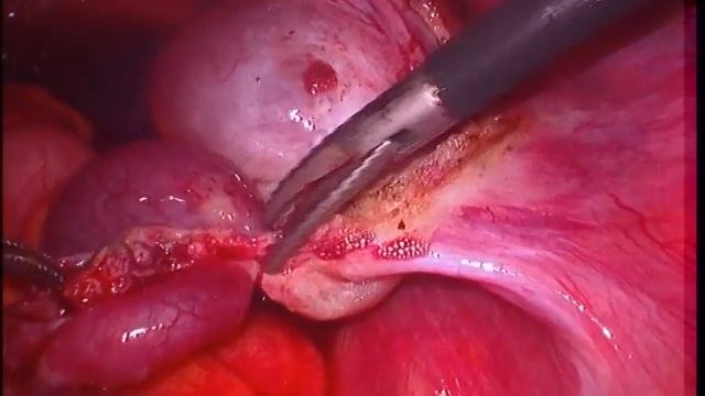 Torsion of a Fallopian tube. Перекрут трубы Лапароскопия Тубэктомия смотреть онлайн