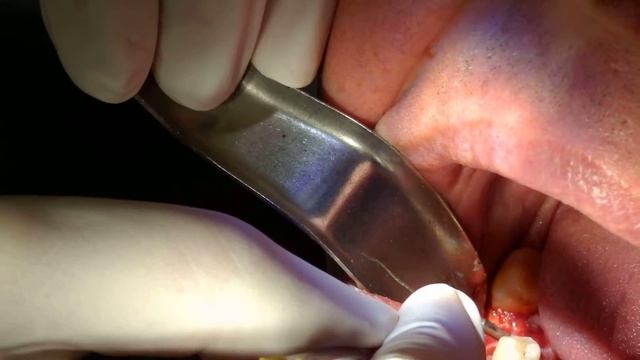 Bone grafting смотреть онлайн