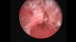 Синехии полости матки. Синдром Ашермана. Аденомиоз.