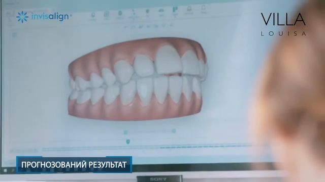 Прозорі капи - елайнери Invisalign смотреть онлайн