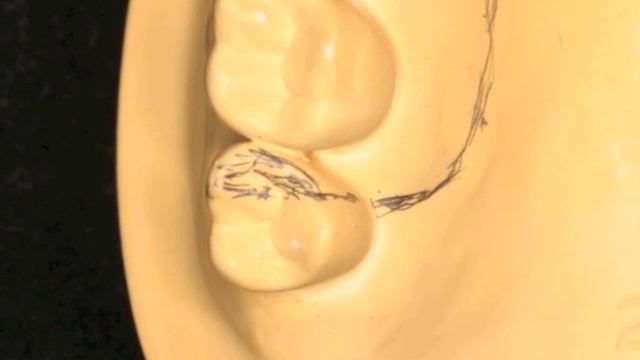 Triad Occlusal Guard смотреть онлайн