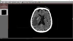 Нарушения мозгового кровообращения 3 КТ ОНМК