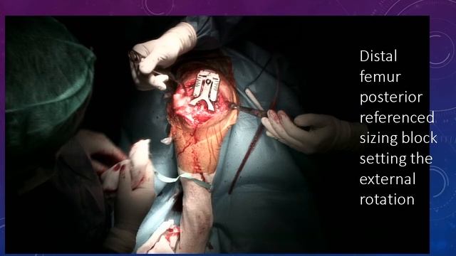 Surgical video- Stryker uncemented TKR смотреть онлайн