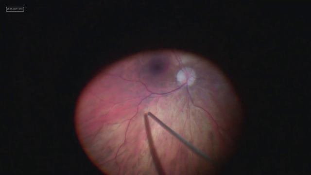 Macular hemorrhage associated with lacquer crack in high myopia. смотреть онлайн