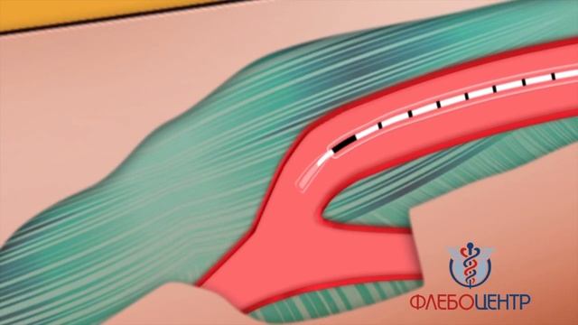 Лазерная облитерация вен с вакуумом VALA смотреть онлайн