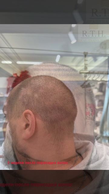 Пересадка волос☀️
Результат через 2 недели смотреть онлайн