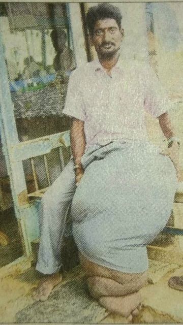 Wuchereria Bancrofti - బోదకాలు - #wuchereria