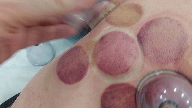 эффект сухой хиджамы смотреть онлайн