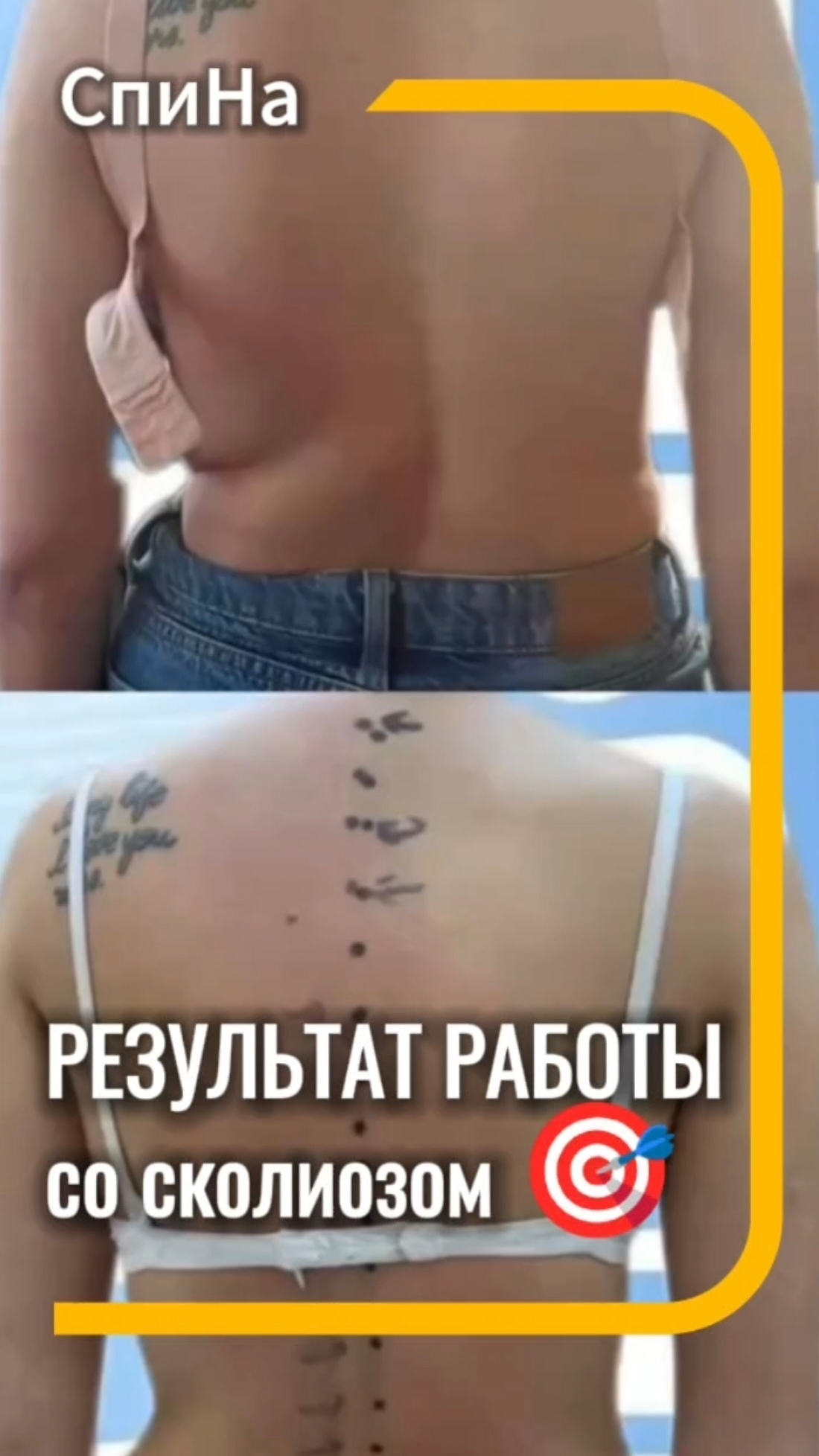 Результат работы со сколиозом. #костоправмосква #здоровьеспины #сколиоз #осанка смотреть онлайн