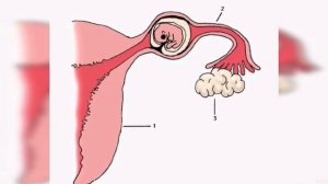 Бачадондан ташкари хомиладорлик! Битта труба билан хам хомиладор булиш