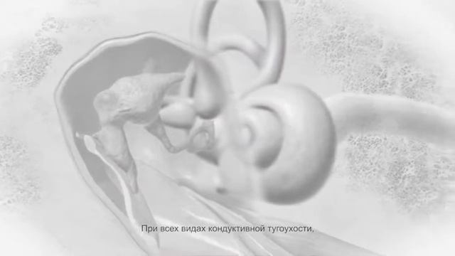 Conductive Hearing Loss (Russian) / Кондуктивная тугоухость смотреть онлайн