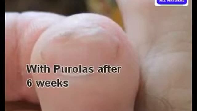 Tinea Pedis treatment " dermatophytes" смотреть онлайн