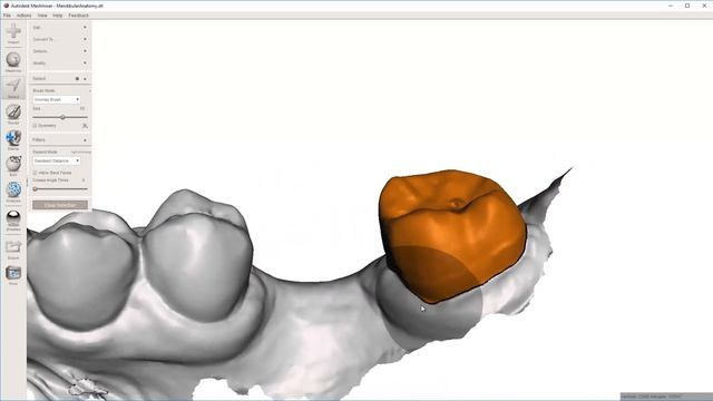 MeshMixer: Virtual Tooth Extraction - Lasso Selection смотреть онлайн