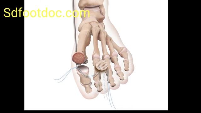 Hallux rigidus Cartilage replacement with Cartiform смотреть онлайн