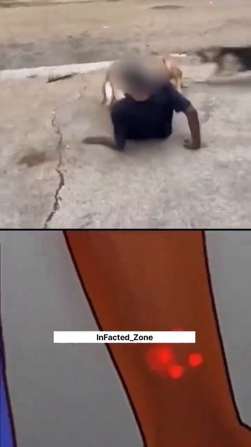 Rabies 🐕 A Killer Disease || InFacted_Zone