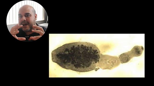 Caso Clínico USMLE(1). Echinococcus granulosus o Tenia del perro. Quiste Hidatídico. смотреть онлайн