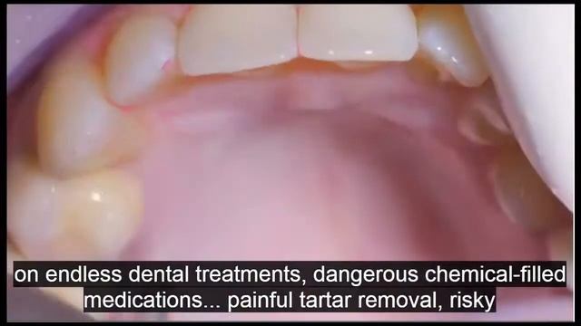This Stops Bleeding Gums, Removes Tartar And Strengthens Your Teeth смотреть онлайн