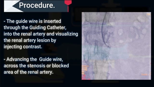#renalartery  #RenalArteryStenting #cathlab #angioplasty  Procedure On Renal Artery Stenting.