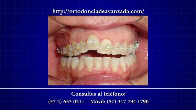 Brackets de auto ligado смотреть онлайн