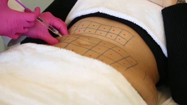 Resultados da Lipo Enzimática | Dr Luciane Bravi Explica